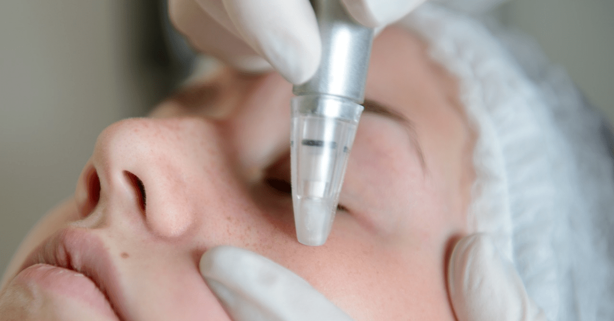 Microneedling vs Microdermabrasion: Which is Right for Me? | First Impressions Clinic